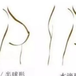 胸部整形术要多少钱,影响因素与价格范围一览