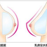 隆乳整形,塑造完美曲线，重塑自信风采