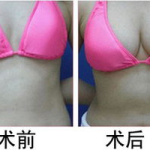 胸部整形哪个医院最好,哪家医院独占鳌头？”