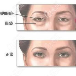 眼袋整形术,眼袋整形术的全面解析