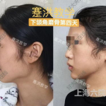 下颌整形,下颌整形技术解析与美学追求