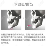 短下巴整形手术多少钱,价格影响因素及参考范围”