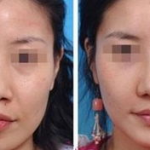 鼻尖整形对比图,美丽蜕变，见证专业技艺
